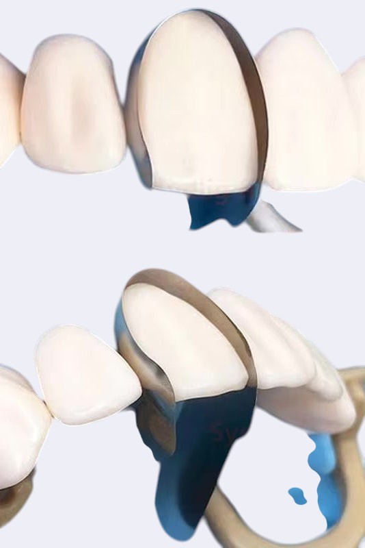 Bandes de matrices métalliques dents antérieures