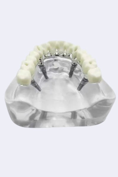 DENTISTOOLBOX dental implant bridge model showing crowns on implants and adjacent teeth. Clear acrylic base.